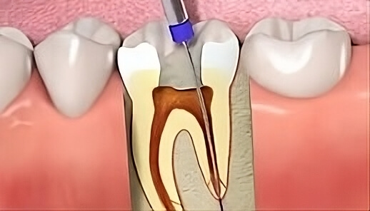 tratamientos endodoncia