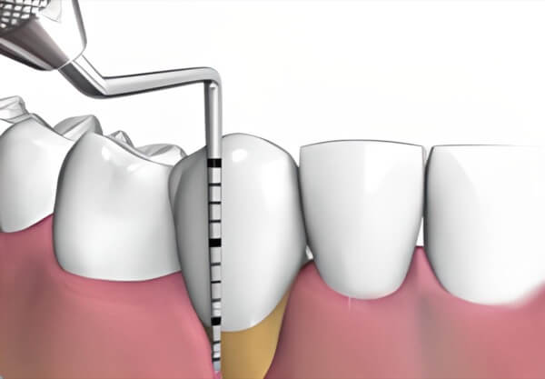 tratamientos periodoncias